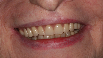 Healthy repaired smile