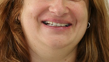 Woman with discolored smile