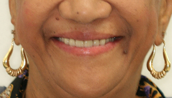 Smile with replaced top teeth