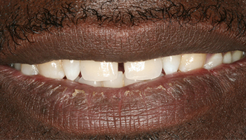 Closeup of flawlessly replaced top teeth