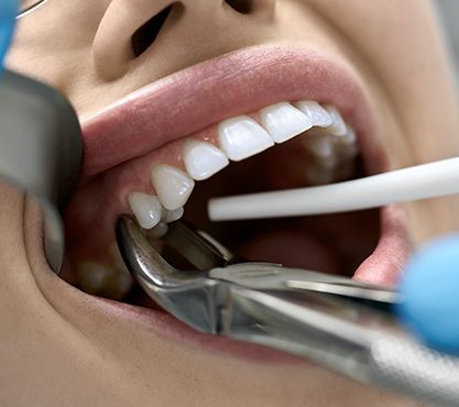 Close up of dental patient during procedure