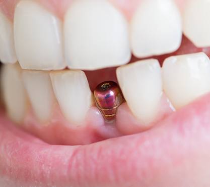 Close up of person smiling with a visible dental implant in their mouth