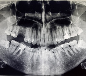 an X ray of a person’s jawbone and facial structure