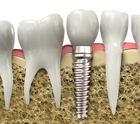 Diagram of dental implant during osseointegration