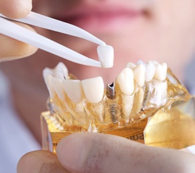 dentist placing a crown on top of a dental implant in a model of the mouth
