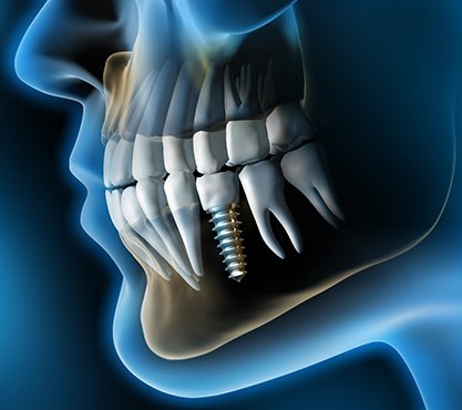 X ray of a person with a dental implant