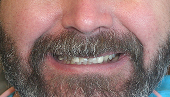 Man with front teeth tilted inward